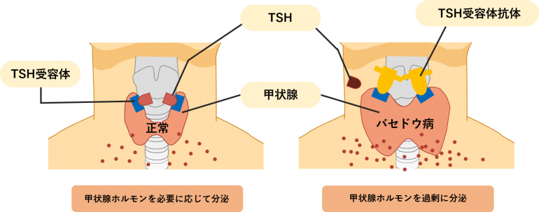 バセドウ病の原因